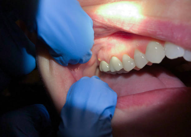 Best Emergency Treatment for Oral Infections in Karns, TN